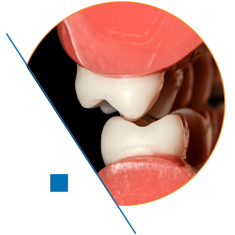 CMD Zähne Okklusion